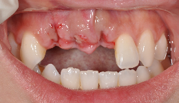 Loss of Three Front Teeth